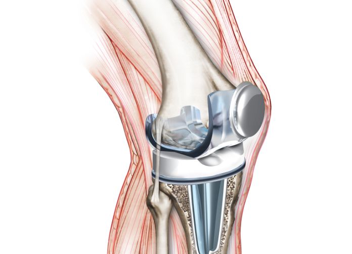 Defective Medical Device Lawyer